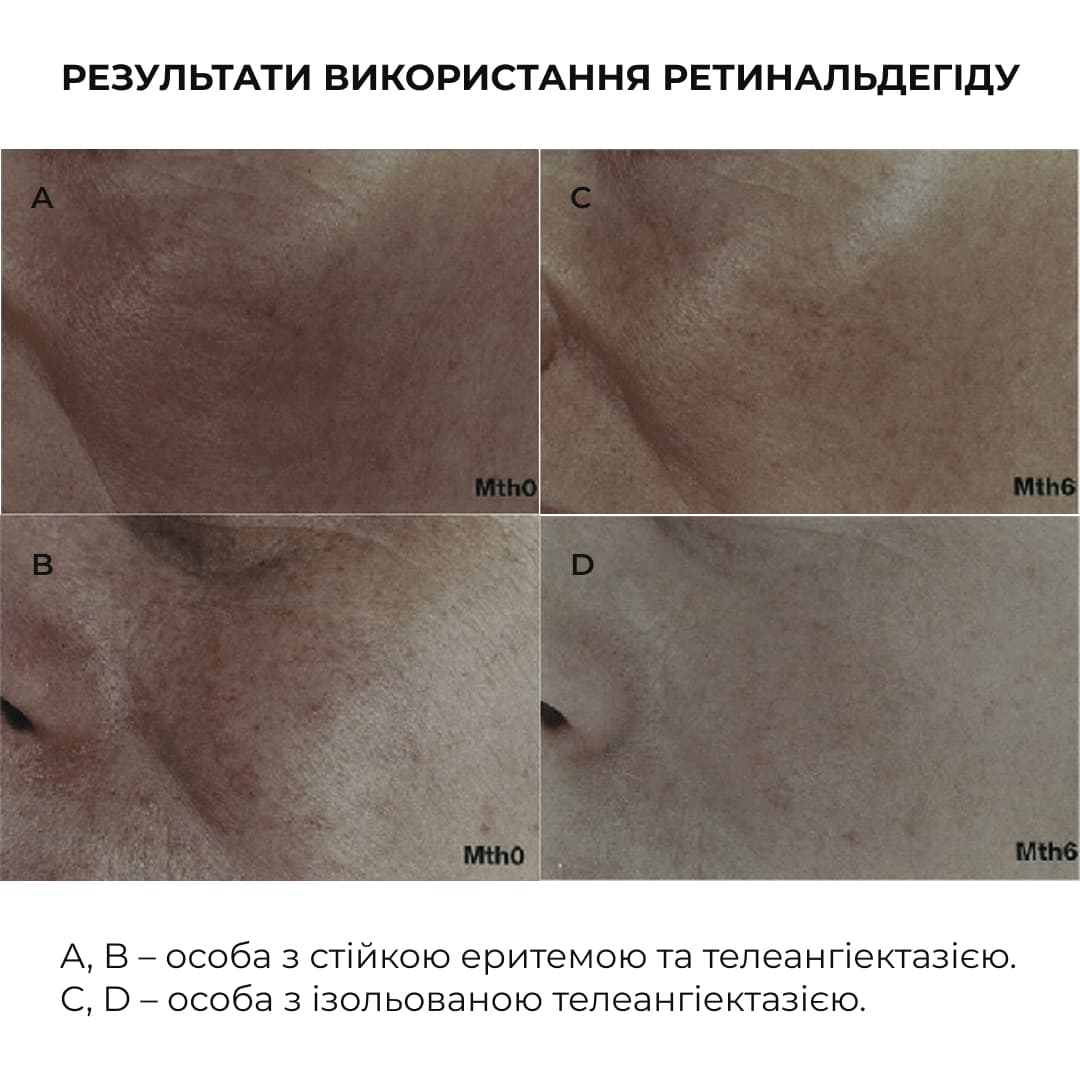 Комплекс для контролю висипань і оновлення шкіри вночі Hillary Night Acne Control & Renewal Kit thumbnail