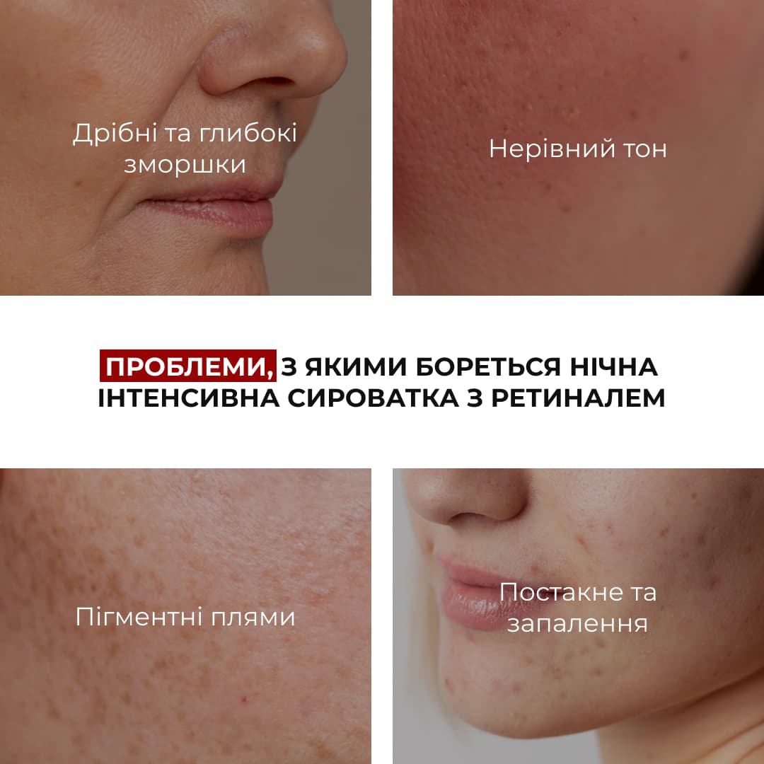 Комплекс для контролю висипань і оновлення шкіри вночі Hillary Night Acne Control & Renewal Kit thumbnail