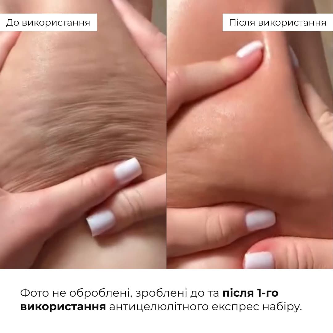 Антицелюлітний експрес курс Hillary Rapid Body Sculpting Program thumbnail