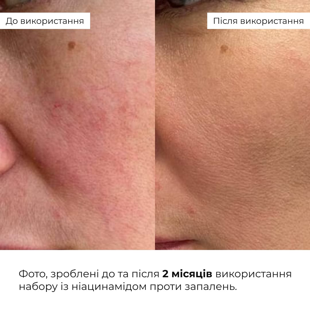 Комплекс для очищення, себорегуляції та захисту шкіри SPF 30 Hillary Cleansing, Oil Control & Skin Protection Complex thumbnail