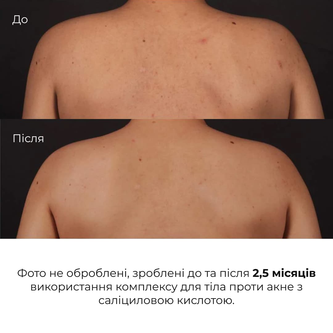 Комплекс проти висипань на тілі та глибокого живлення Hillary Body Acne & Deep Nourishment Complex thumbnail