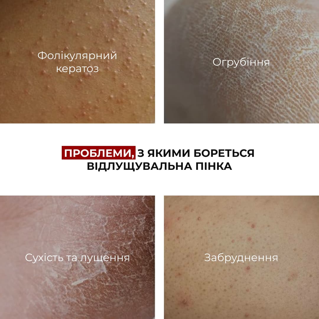 Комплекс для відлущування та корекції висипань на тілі Hillary Exfoliation & Body Acne Correction Complex thumbnail