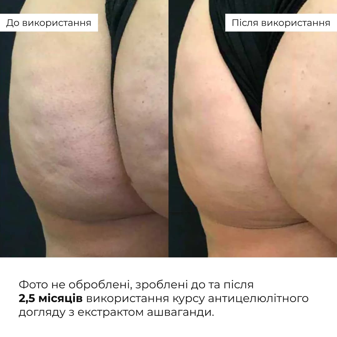 Курс антицелюлітного догляду в домашніх умовах з екстрактом ашваганди Hillary Ashwagandha Anti-Cellulite Care thumbnail