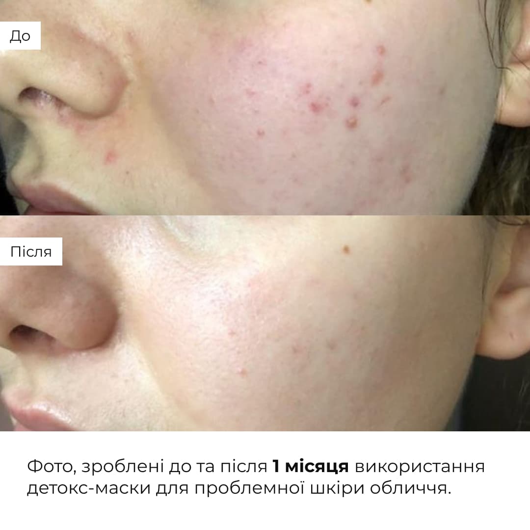 Набір детоксикації та боротьби з акне Hillary Acne Control & Detox Skin Kit thumbnail
