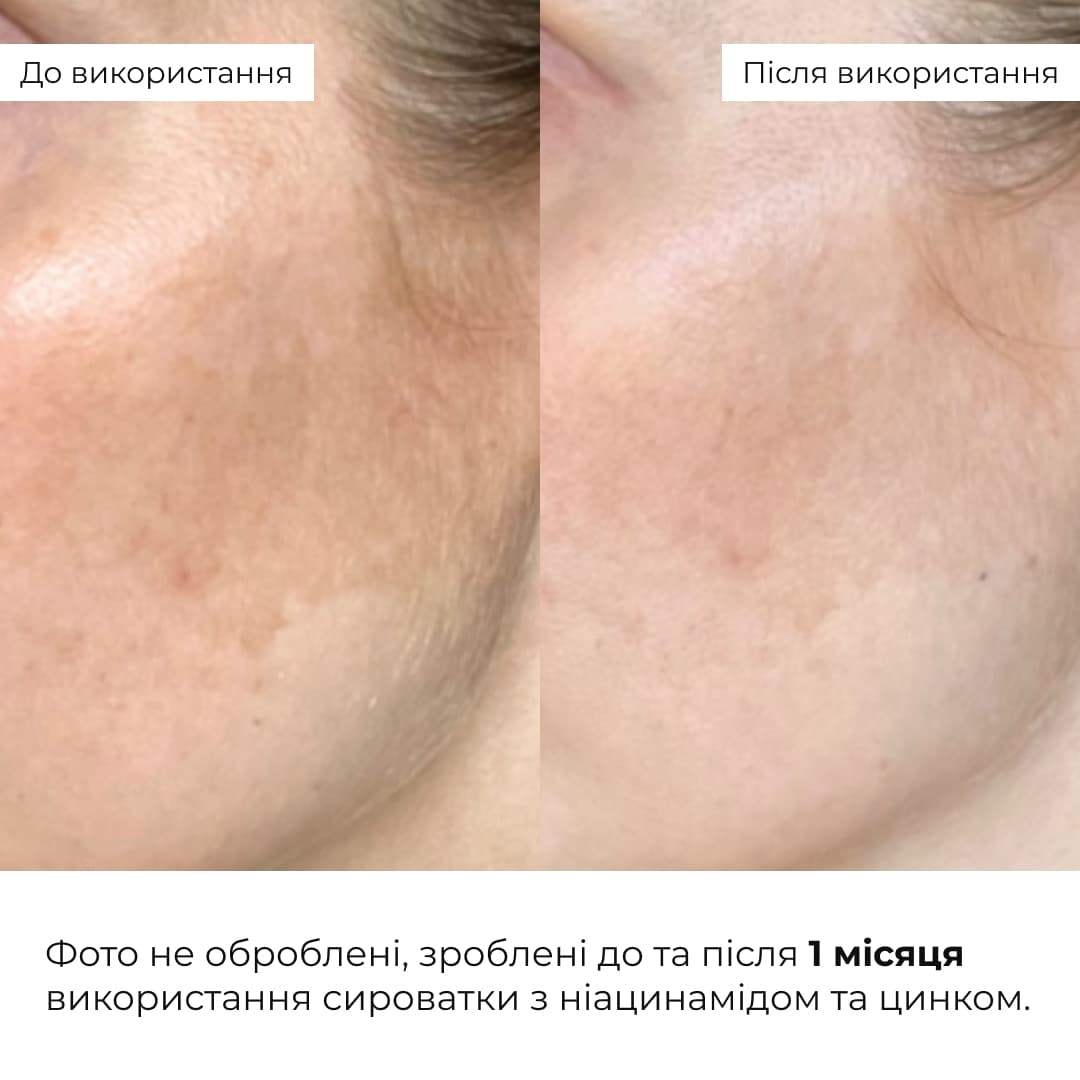 Комплекс щоденного догляду для жирної та комбінованої шкіри Hillary Daily Care Complex for Oily & Combination Skin thumbnail