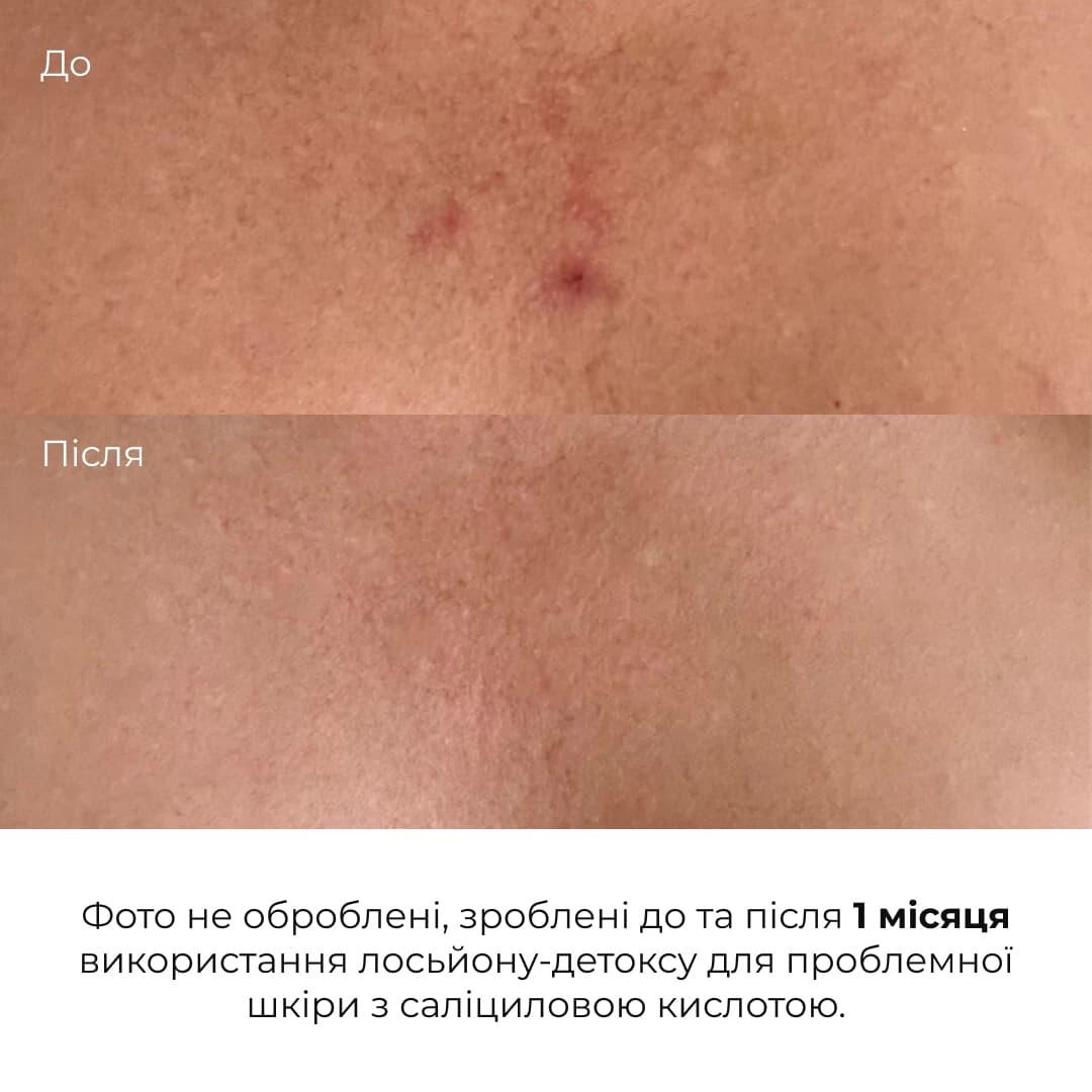 Лосьйон-детокс для проблемної шкіри з саліциловою кислотою Hillary Anti-Acne Salicylic Body Lotion, 150 мл thumbnail