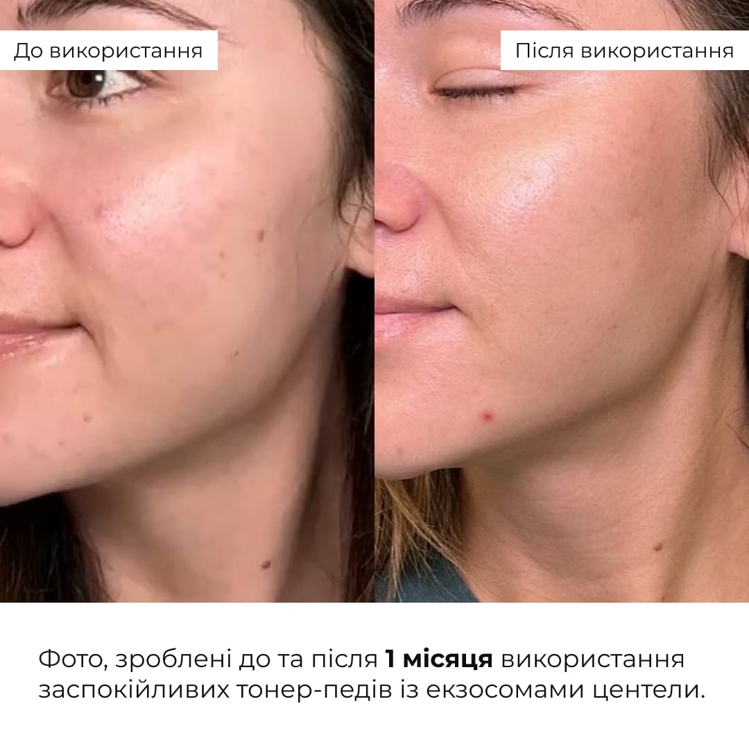 Комплекс для дворівневого оновлення та заспокоєння шкіри Hillary Dual-Level Renewal & Soothing Complex thumbnail