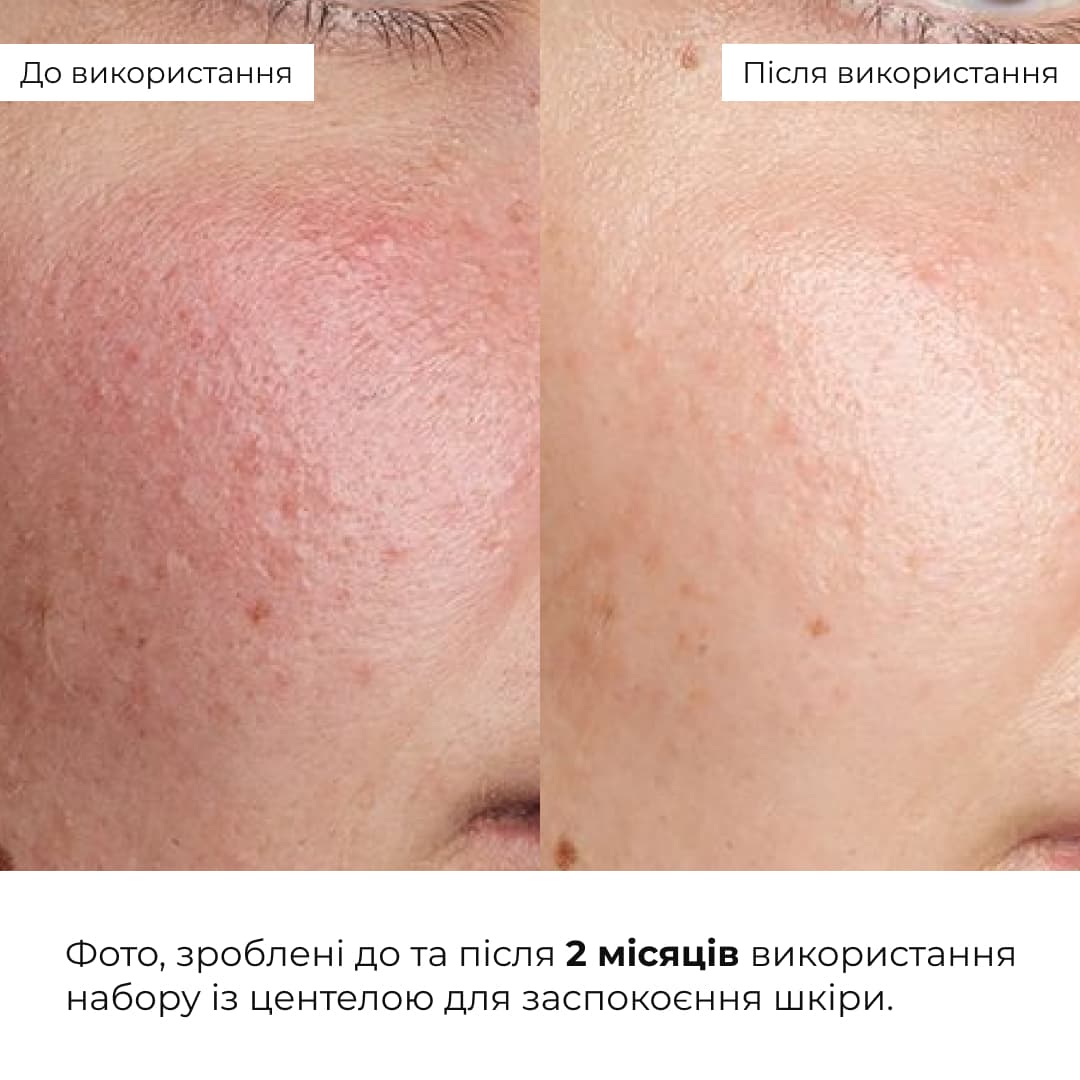 Набір із центеллою для заспокоєння та відновлення шкіри Hillary Centella Soothing & Recovery Set thumbnail