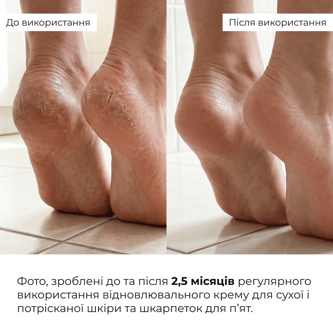 Набір для загоєння потрісканих п’ят Hillary Cracked Heel Repair Set thumbnail