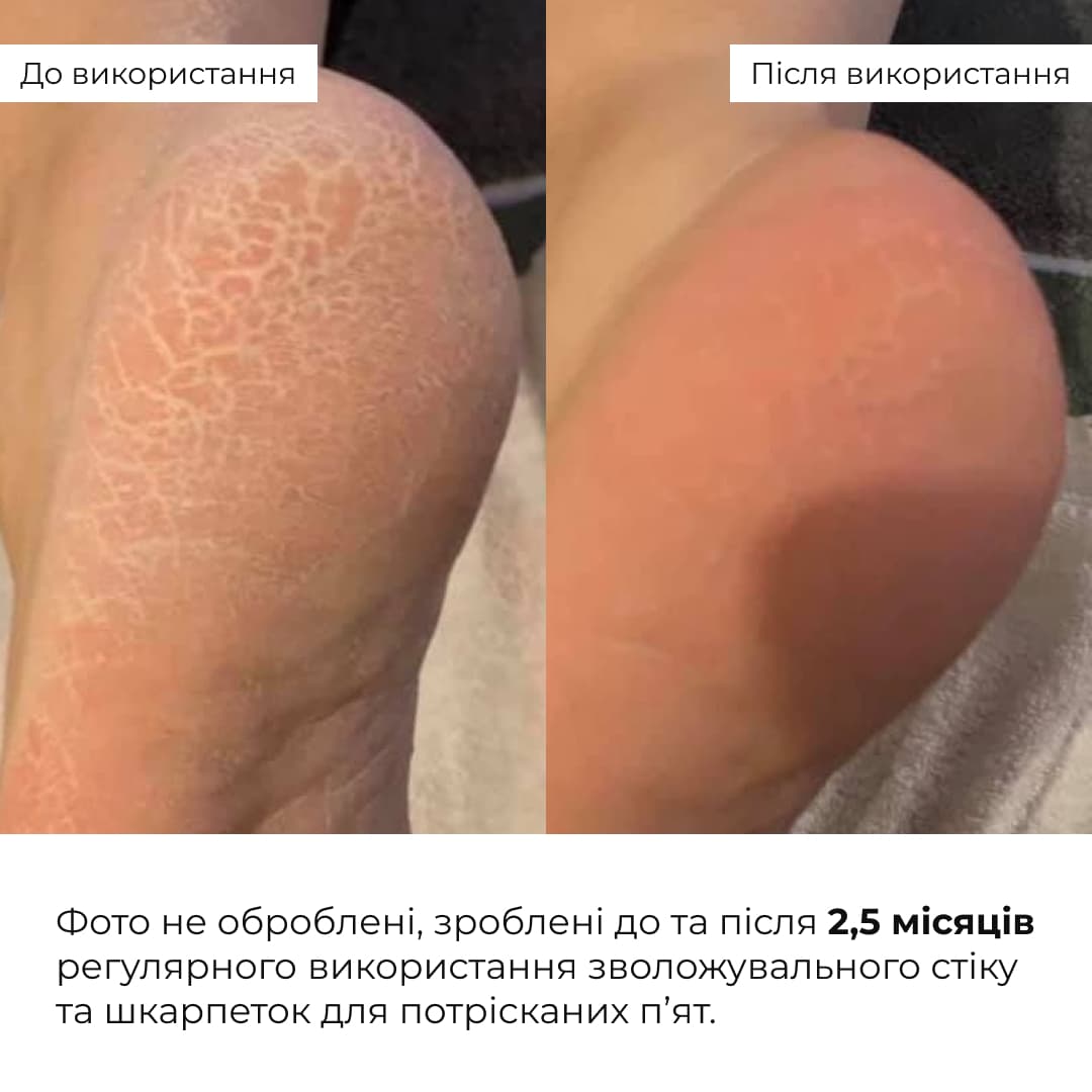 Набір для загоєння потрісканих п’ят Hillary Cracked Heel Repair Set thumbnail