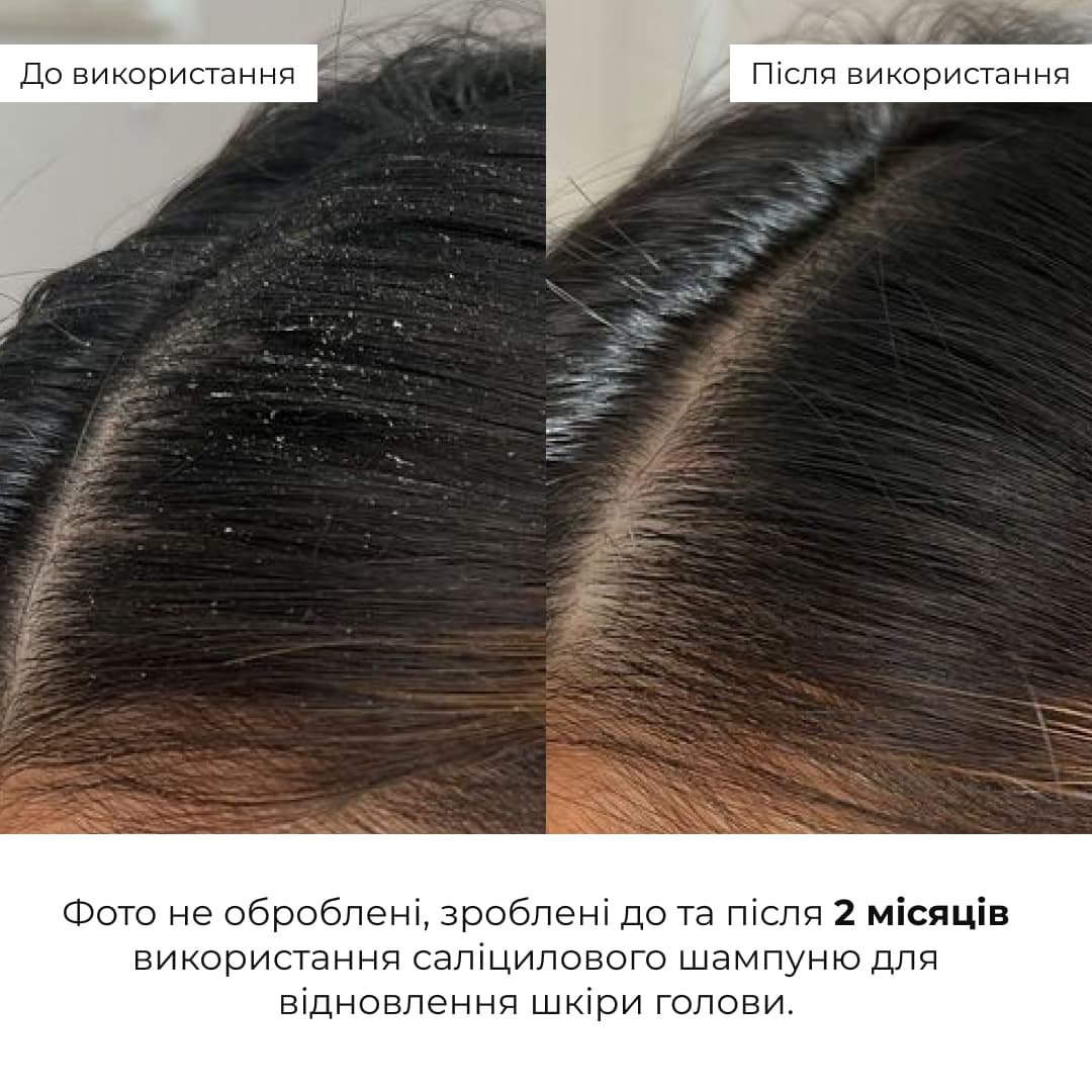 Комплекс для жирної шкіри голови та відновлення пошкодженого волосся HiLLARY thumbnail