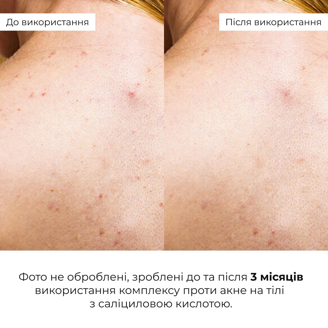 Набір проти запалень і висипань на тілі Hillary Back & Body Acne Care Set thumbnail