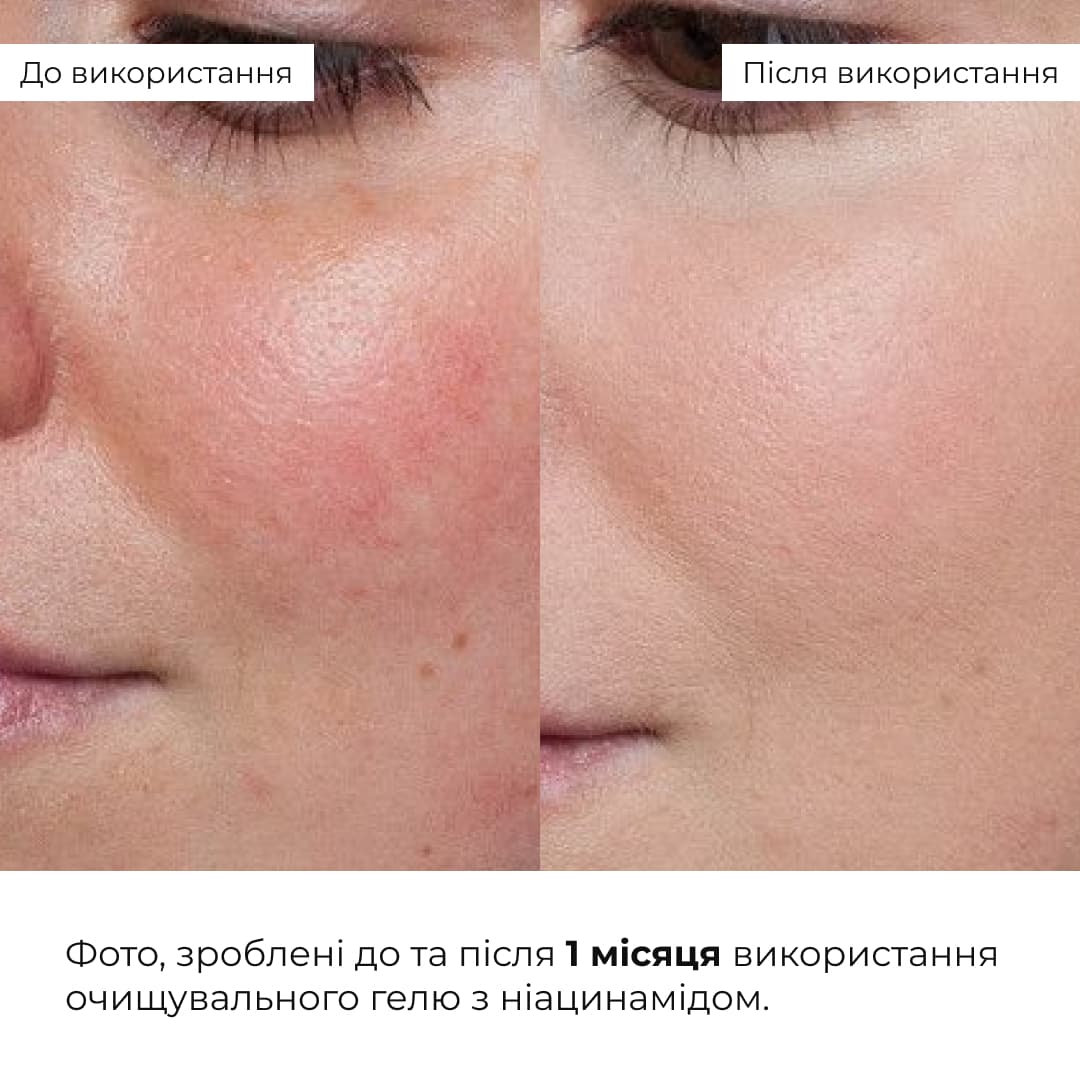 Комплекс антивікового догляду для контролю жирності та зменшення ознак втоми HiLLARY thumbnail