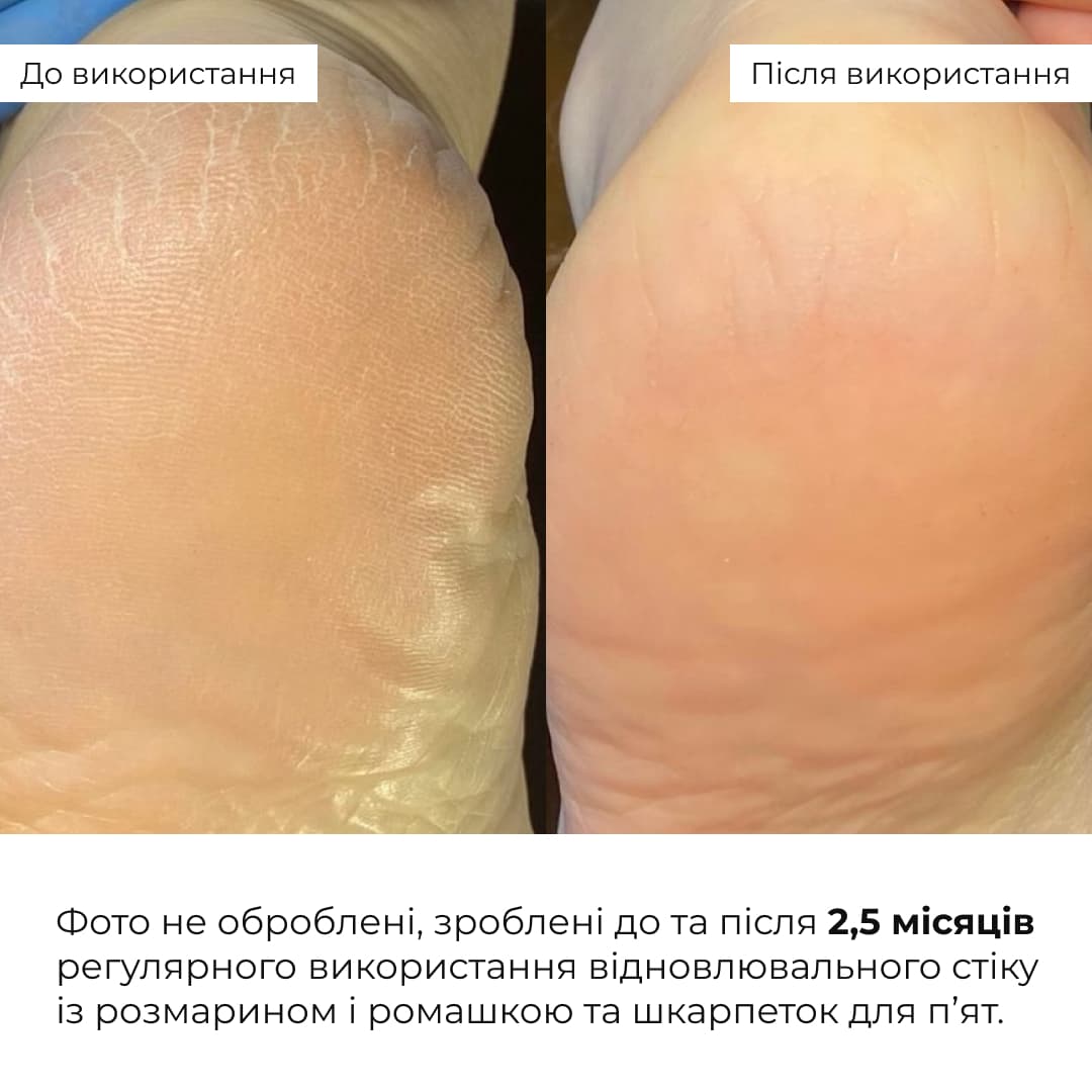 Набір для відновлення сухої та потрісканої шкіри стоп Hillary Dry & Cracked Foot Skin Repair Set thumbnail