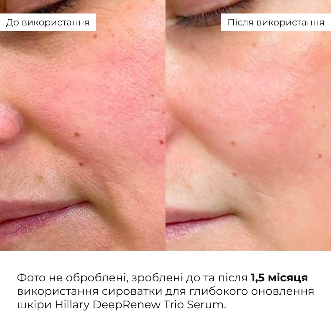 Набір для інтенсивного зволоження Hillary Intensive Hydration Kit thumbnail