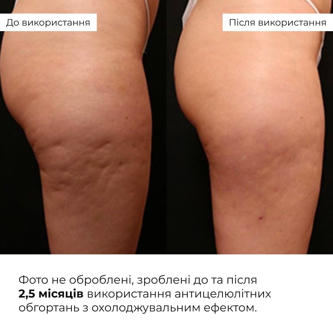Набір антицелюлітних охолоджувальних обгортань Hillary Cooling Anti-Cellulite Wrap Set thumbnail
