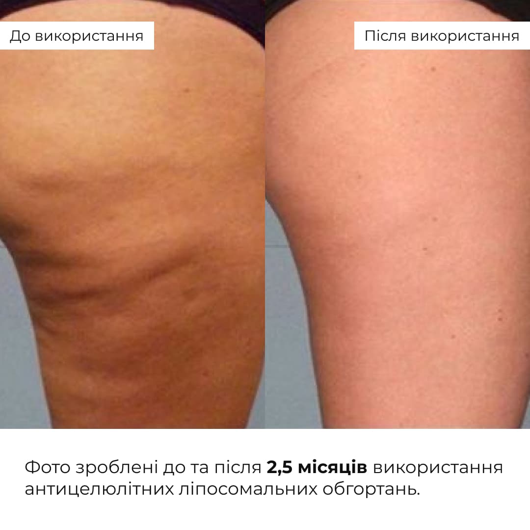 Набір антицелюлітних охолоджувальних обгортань Hillary Cooling Anti-Cellulite Wrap Set thumbnail