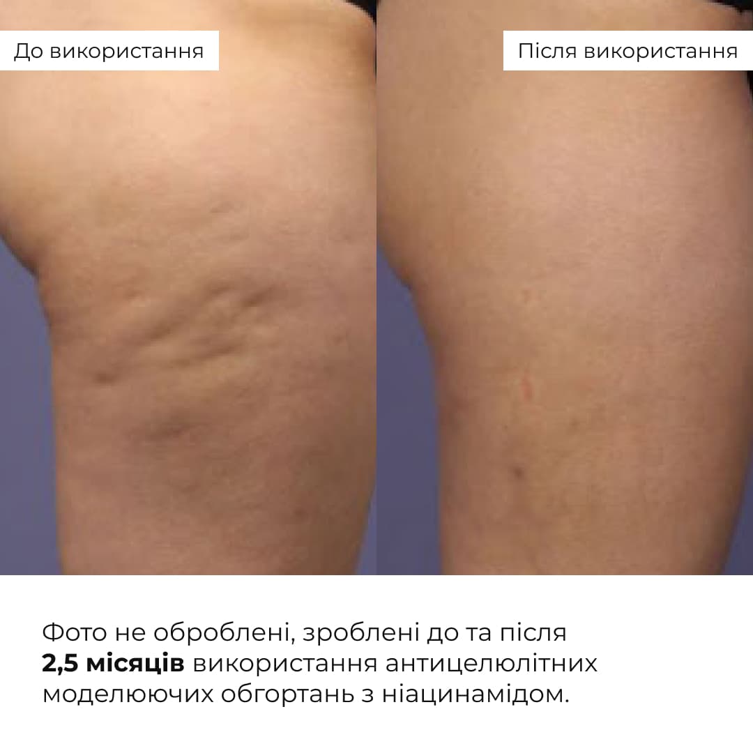 Набір антицелюлітних охолоджувальних обгортань Hillary Cooling Anti-Cellulite Wrap Set thumbnail