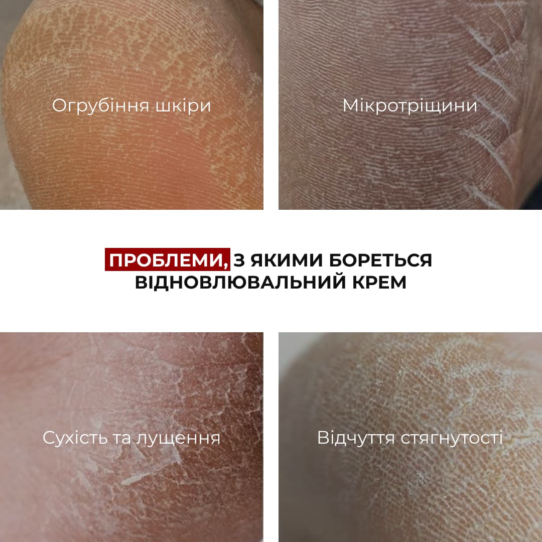 Комплекс для загоєння тріщин та пом’якшення п’ят Hillary Cracked Heel Repair & Softening Complex thumbnail