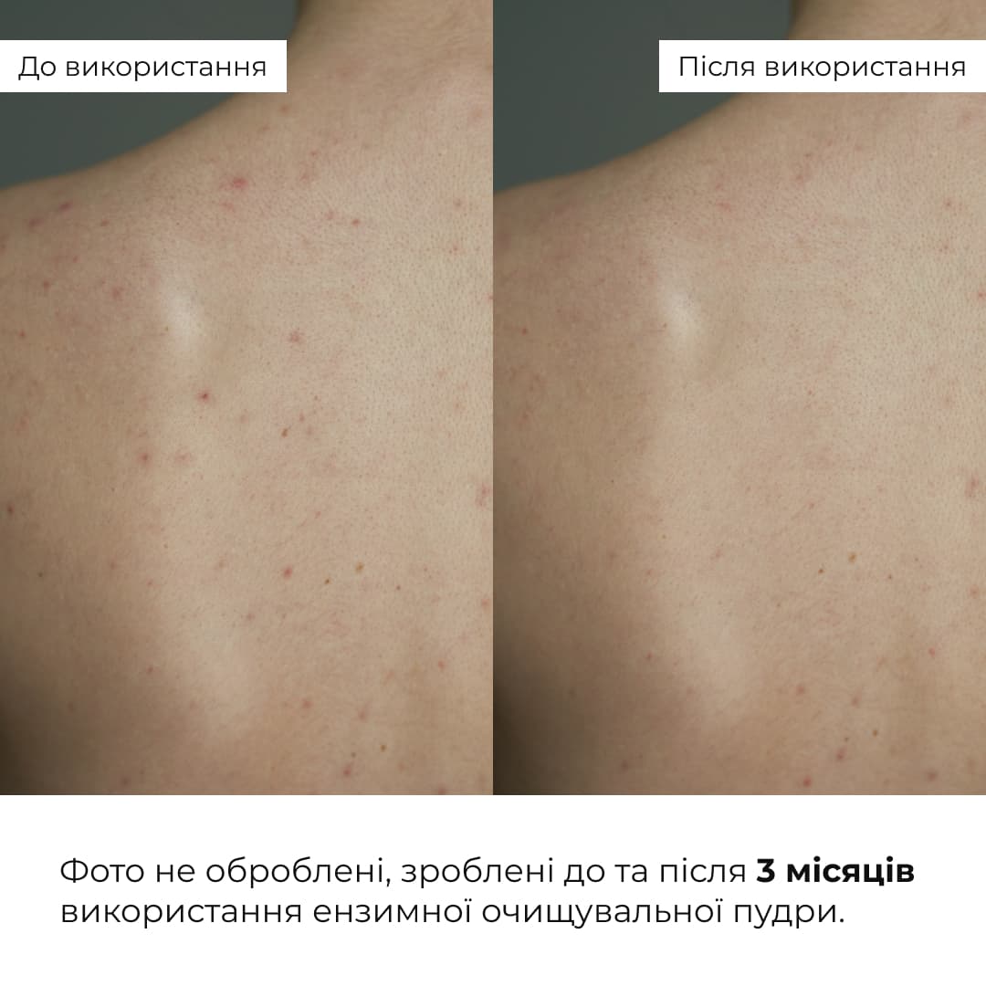 Набір проти жирності та висипань Hillary Anti-Oil & Breakouts Set thumbnail