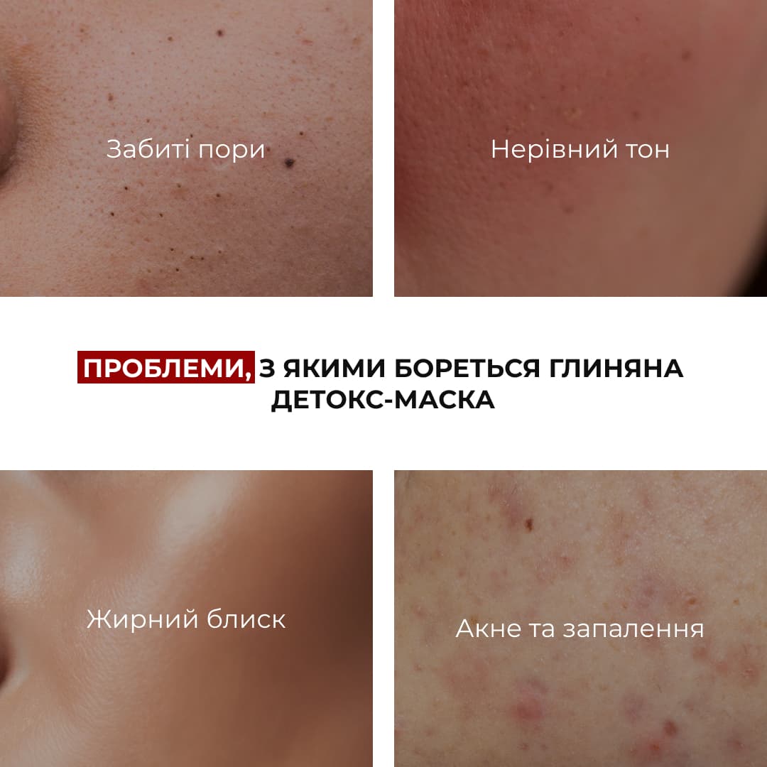 Комплекс нічного догляду для себорегуляції та корекції висипань Hillary Night Care Complex for Oil Control & Acne Correction thumbnail